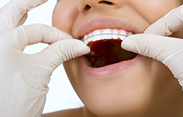 歯の移動・定期通院