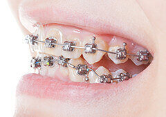 一般的な矯正歯科治療
