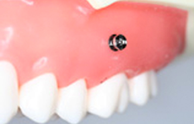 歯科用アンカースクリューを使用した矯正治療の特徴